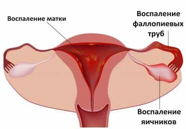 Воспаление яичников, труб и матки